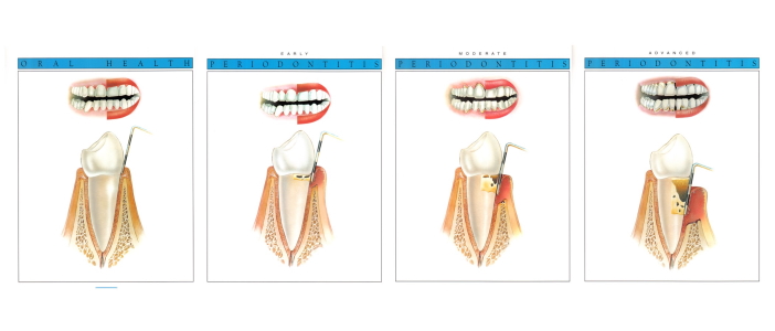 Deep Scaling & Cleaning  (Root Surface Debridement)